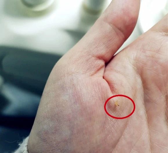 做了窝沟封闭还会蛀牙,蛀齿还需要做窝沟封闭吗