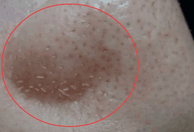 鼻子挤出白粒是螨虫吗,鼻子毛孔里挤出白色膏状物怎么办