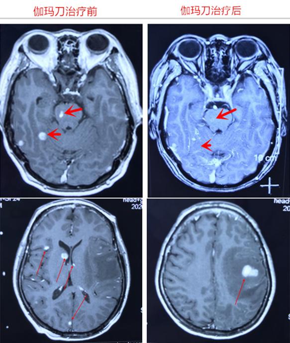 脑部肿瘤可以通过鼻子切除吗,脑部肿瘤手术后应该怎样治疗