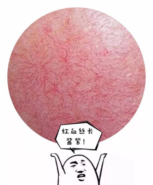脸上有红血丝平时应该怎么护肤呢,脸上有红血丝需要怎么护肤