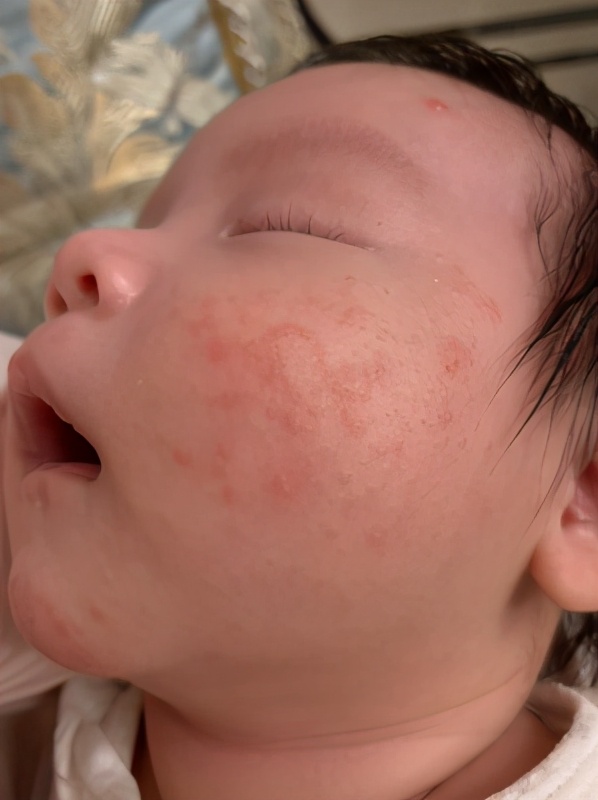 宝宝湿疹严重反反复复怎么办,宝宝湿疹反反复复一直不好怎么办