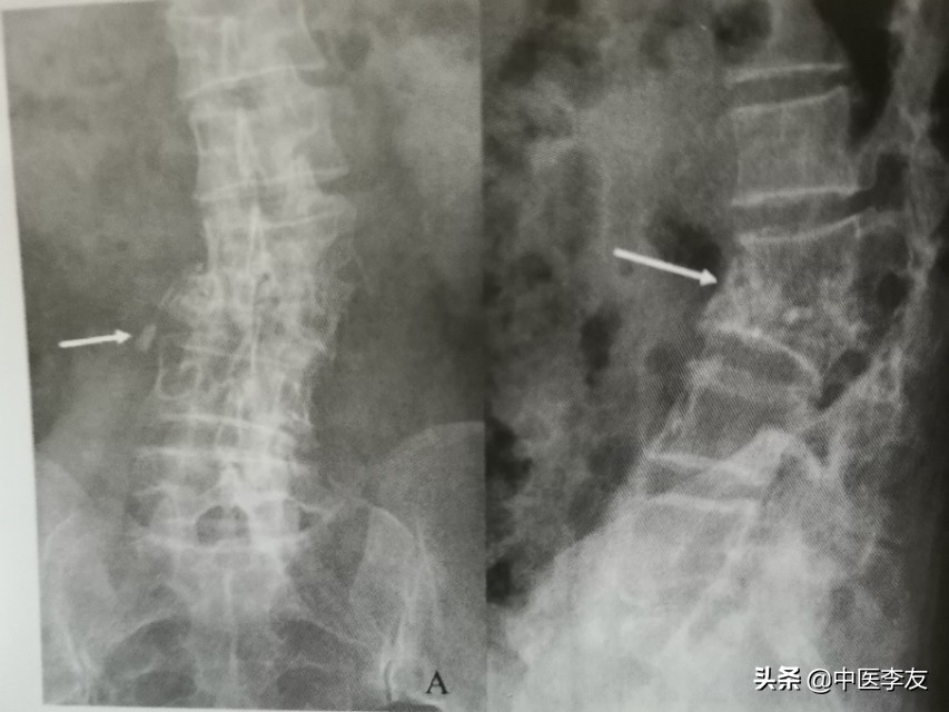腰椎骨结核治愈后出现腰疼,脊柱结核腰痛怎么治