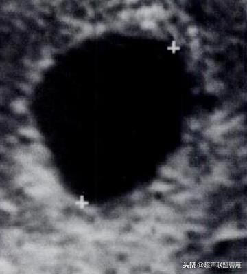 3毫米卵黄囊未见胎芽正常么,40多天的卵黄囊