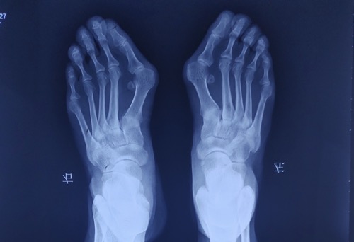 拇外翻导致的脚趾间老茧,拇外翻脚掌前面有茧