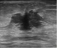 乳腺恶性肿瘤彩超表现,乳腺结节良性恶性彩超对照图