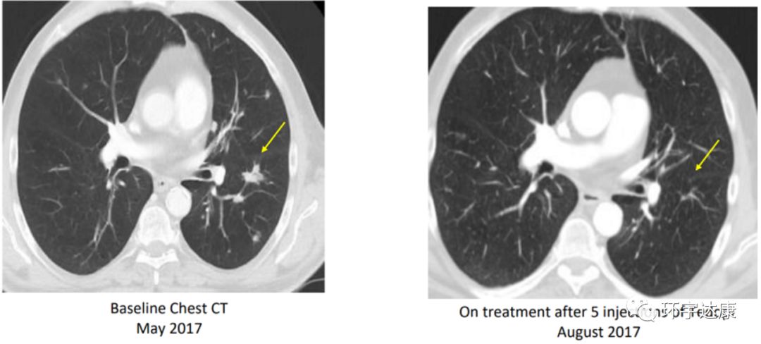 癌症治疗最新成果,2023癌症治疗最新成果