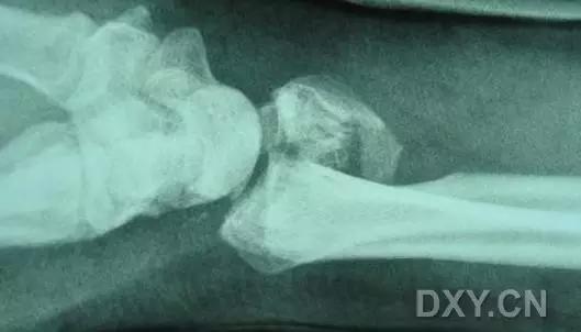 特殊骨折类型,特殊骨折体征