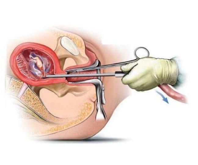 女生做过流产医院有记录吗,第一次做流产手术会有什么影响