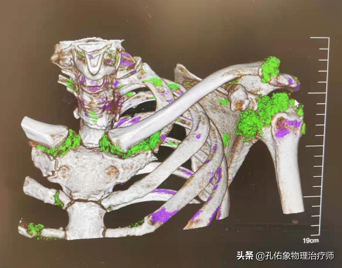 手指肿胀有硬硬的感觉,手指有结节有僵硬疼痛是什么病