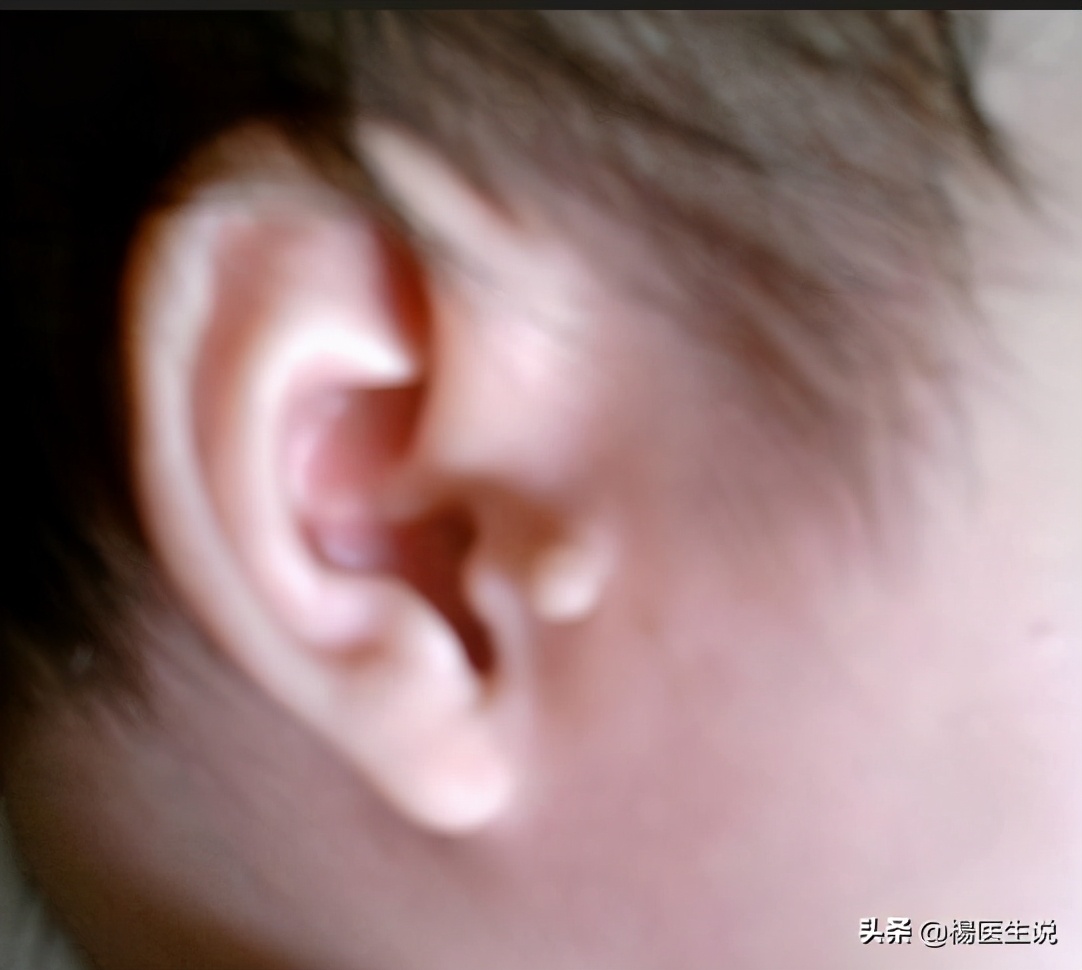 耳朵脖子后面长了个肉瘤叫什么病,脖子上小肉瘤用什么药去除