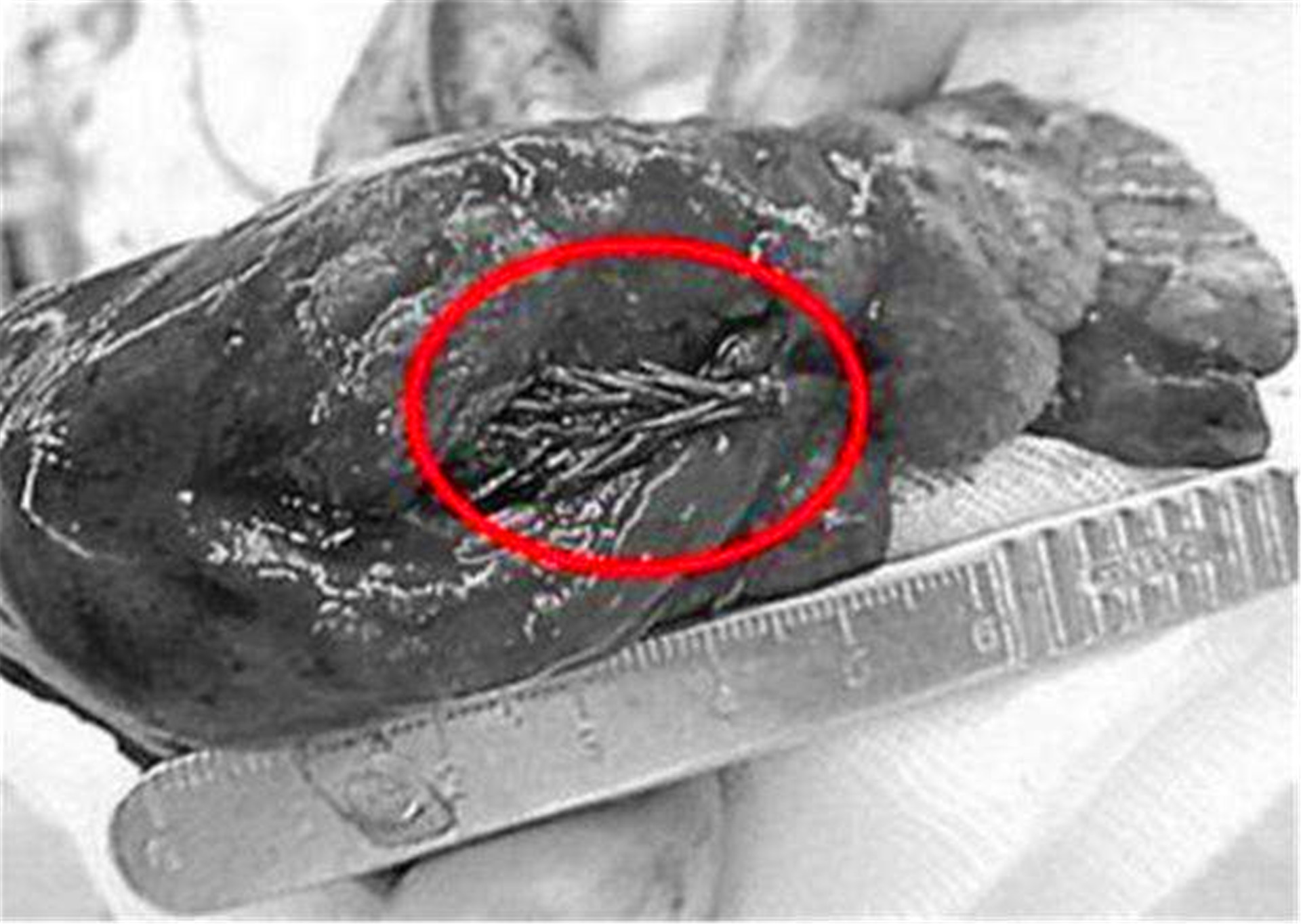 男子确诊肺癌早期被医生劝回,男子肺癌手术发现长了一棵冷杉树