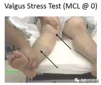 左膝关节内侧副韧带1度损伤,膝关节外侧副韧带撕裂的症状