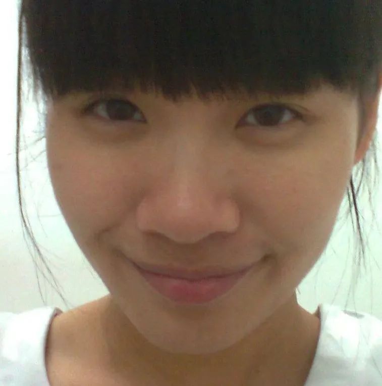 蒜头鼻怎么自己矫正,蒜头鼻塌鼻梁朝天鼻怎么改善