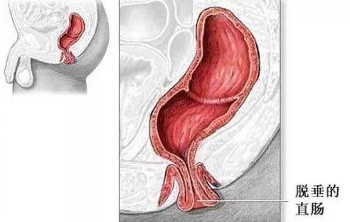 肛门潮湿是怎么回事男性用什么药,肛门瘙痒是什么原因
