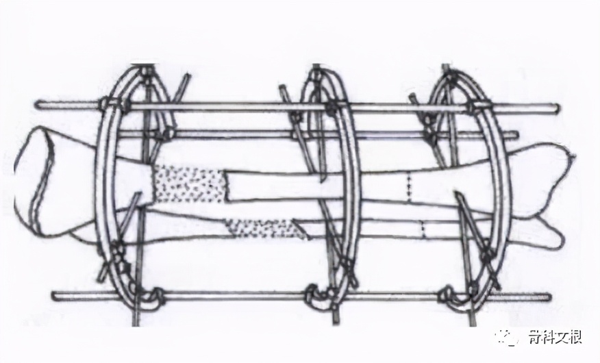 骨折了怎么一直不消肿吃什么药,骨折延缓愈合和骨不连的区别在哪