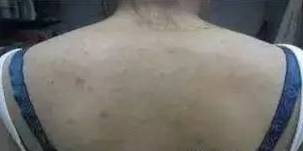 男性背后长疙瘩红红的是什么原因,背后和胸前长红点是什么原因