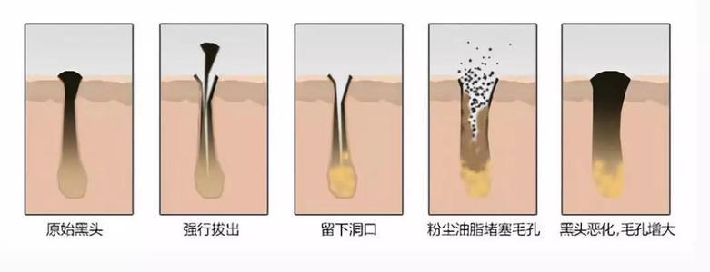 毛孔粗大怎么办教你一招,毛孔粗大怎么办护肤步骤