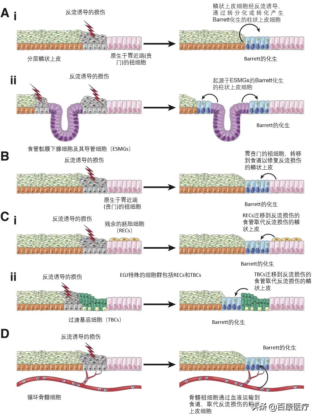 反流性食管炎究竟该怎么治,为何反流性食管炎会消化慢