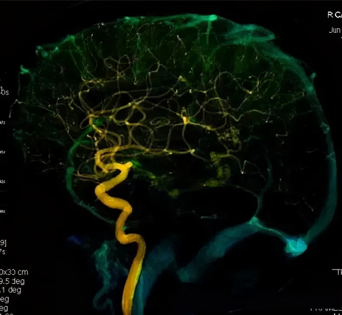 脑血管的照片,健康的脑血管图片
