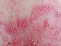 蛇胆膏治疗带状疱疹,蛇胆疮疱疹用什么药最好