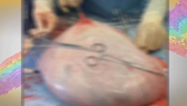 女子怀孕37周肚子巨大无比刨宫产取出25斤囊肿孩子只有5斤4两