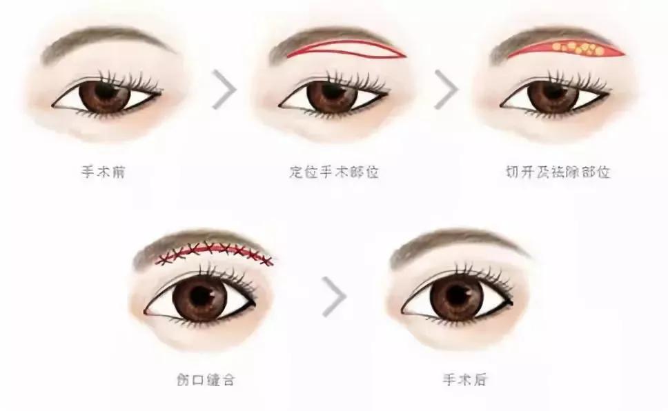 一举三得的起针方法,一举三得