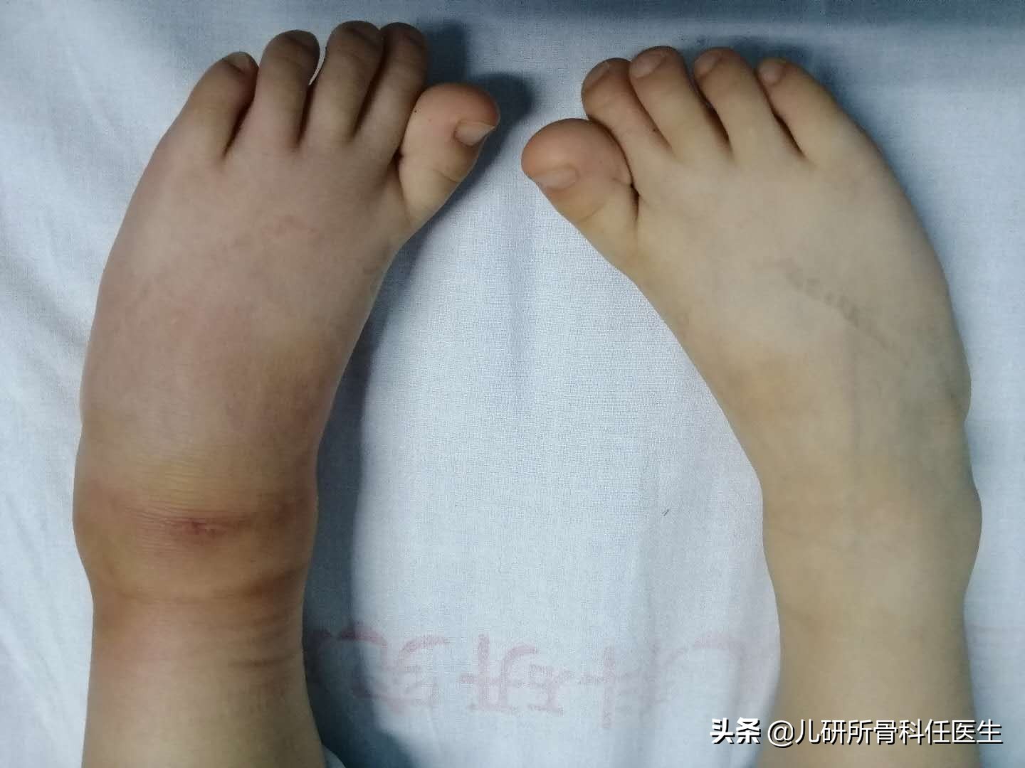 宝宝被蚊虫叮咬要怎么处理,宝宝被蚊虫叮咬试试这几招