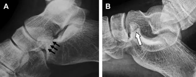 值夜班急救措施,放射科容易漏诊的骨折