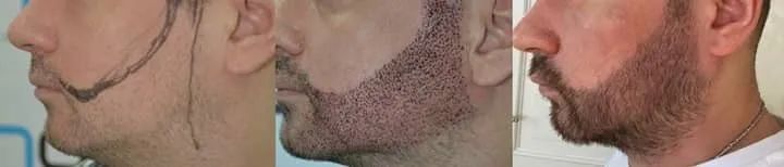 中国人植发,植发的外国人