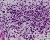 菁讲:你所不知道的横纹肌肉瘤