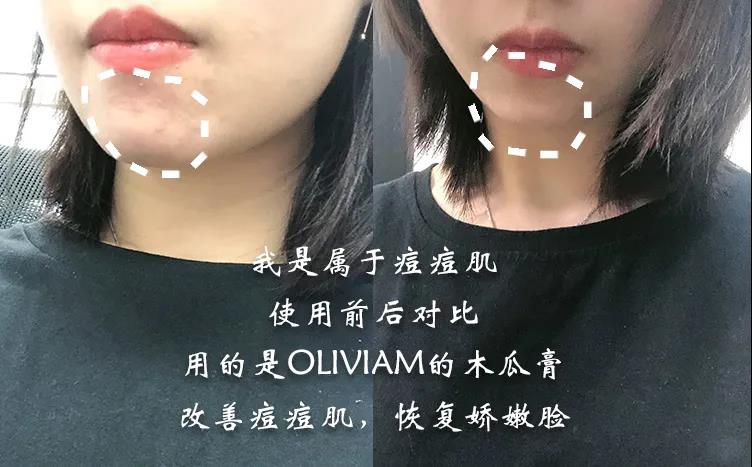 澳洲木瓜膏可以祛痘消炎吗,木瓜膏祛痘疤