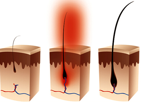 头发稀疏是毛囊坏死还是毛囊萎缩,毛囊萎缩还能长出头发吗