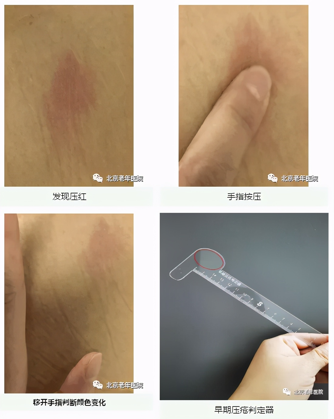 老年人防压疮的饮食照护原则,三度压疮老年人的家庭照护