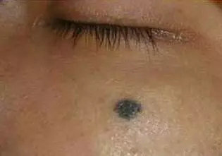 皮秒太田痣激光恢复过程,治疗太田痣费用贵吗