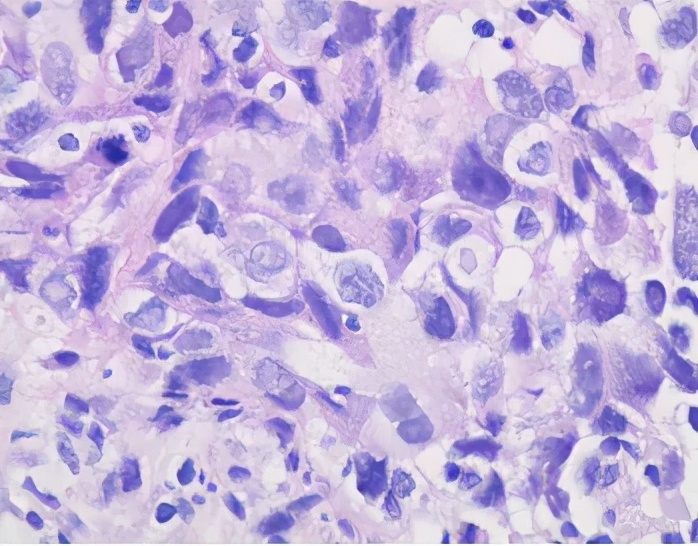 肺癌晚期可以靶向加免疫治疗吗,肺癌晚期化疗加免疫治疗有效吗