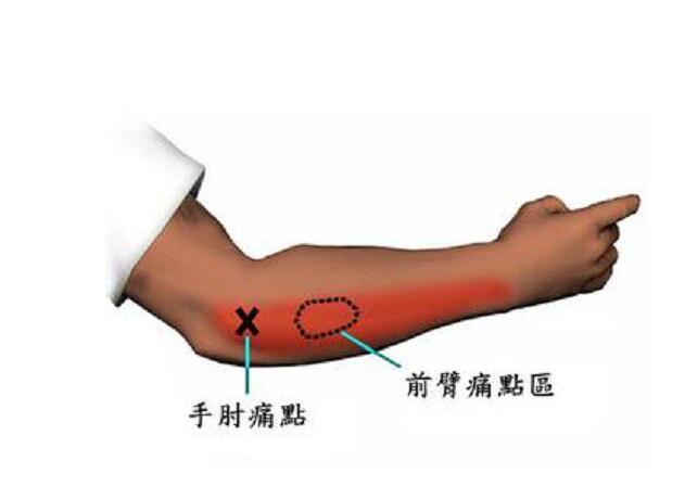 扭力棒治疗网球肘,扶他林治疗网球肘