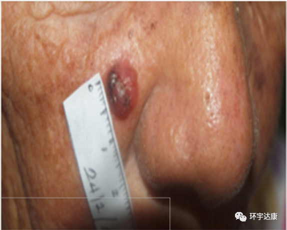 古巴癌症疫苗效果怎么样,古巴已经发明了抗肺癌的疫苗吗