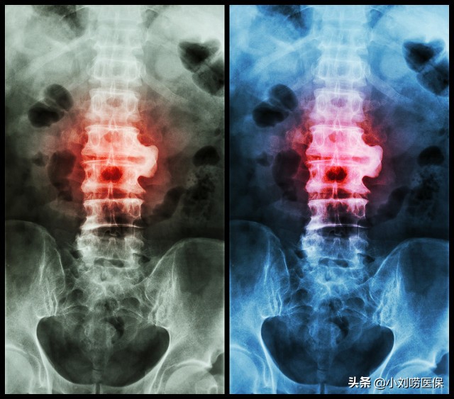 重庆强直性脊柱炎慢性病报销,强直性脊柱炎是慢性病可以报销吗