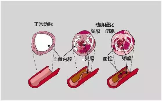 中医教你识别冠心病,人类健康第一杀手是哪种疾病