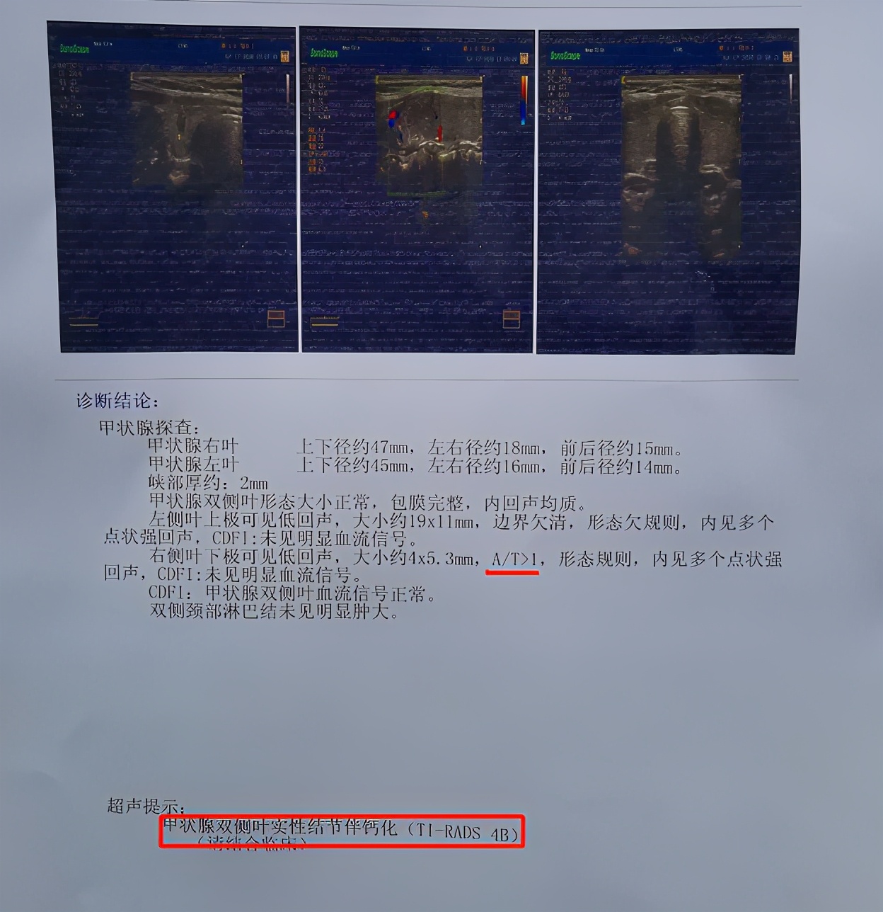 结节有钙化是危险信号吗,结节发生了钙化是怎么回事