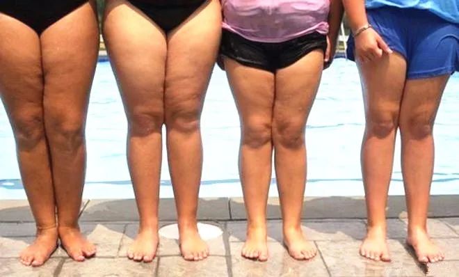 大腿粗的人运动磨腿根怎么办,细腿走路磨大腿内侧怎么办