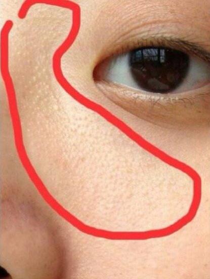 毛周角化中药调理治好了,重度汗管角化症最有效的治疗方法