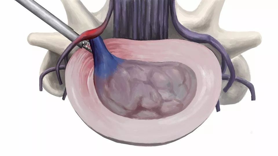 腰椎间盘突出并腰椎管狭窄怎么办,腰椎管狭窄腰椎间盘突出怎么治