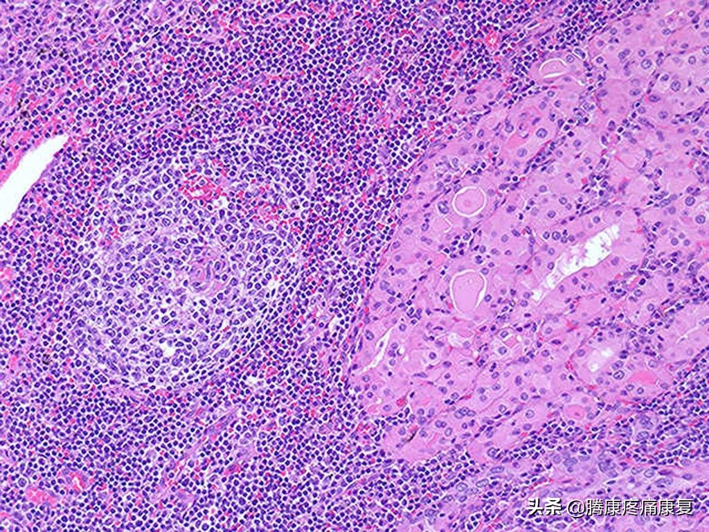 桥本甲状腺炎90天治疗方案,nac对桥本甲状腺炎的作用