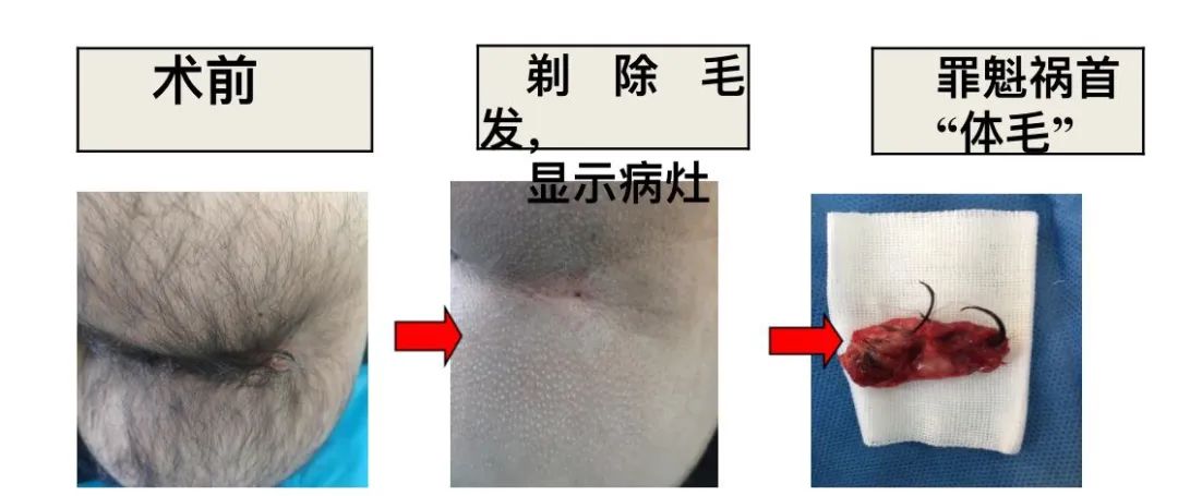 骶尾部藏毛窦真实经验,骶尾部藏毛窦多发于什么年龄