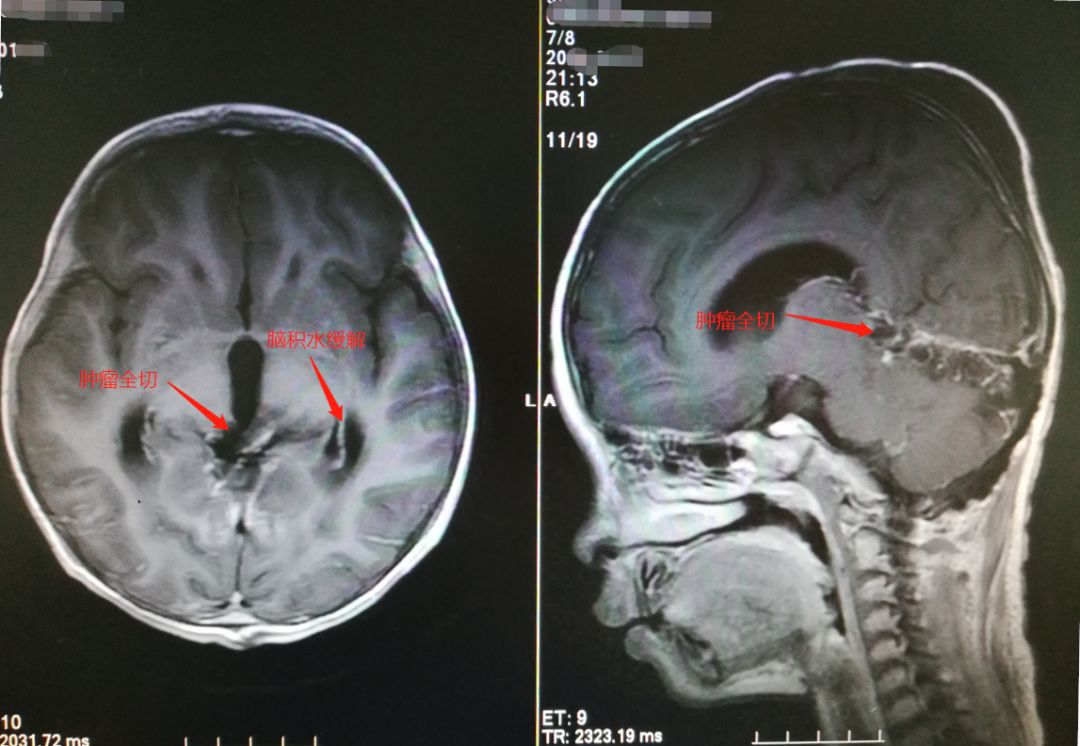 五岁男孩牙齿一长一短,5岁男孩的牙齿居然长在了脑袋里