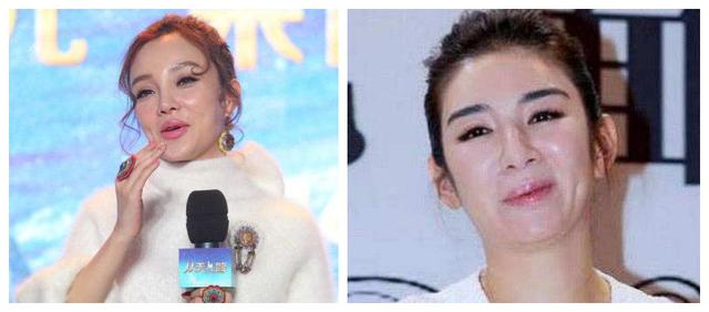 玻尿酸是无底洞,全脸打了玻尿酸需要注意什么