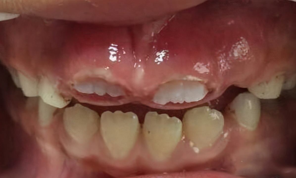 7岁小孩门牙掉了一年没长怎么办,7岁小孩门牙掉了一直不长怎么办