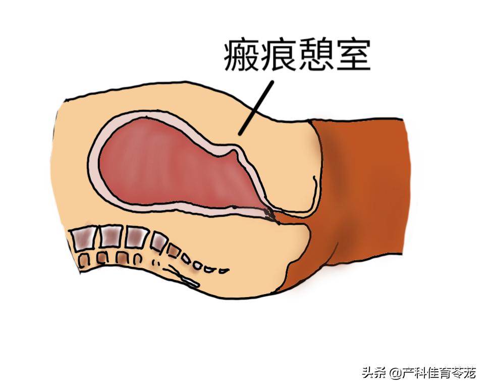 剖腹产后子宫出血是正常的吗,剖宫产术后又流血