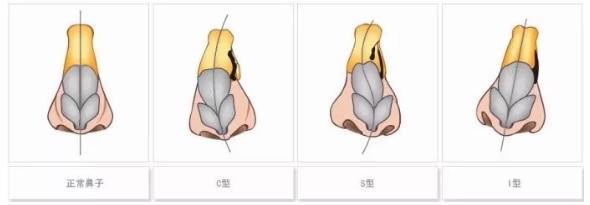 鼻子歪斜矫正手术,鼻子歪斜怎么自我矫正